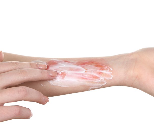 Rashes and Burns Treatment
