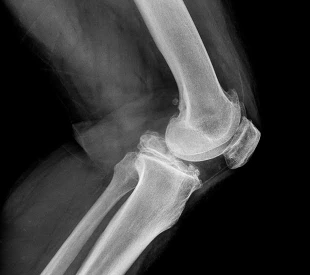 Why Do I Need Joint X-Rays