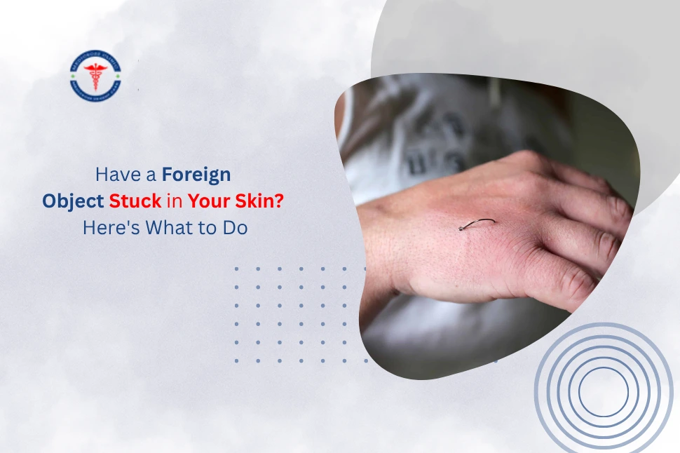 Have a Foreign Object Stuck in Your Skin Here 39 s What to Do 1