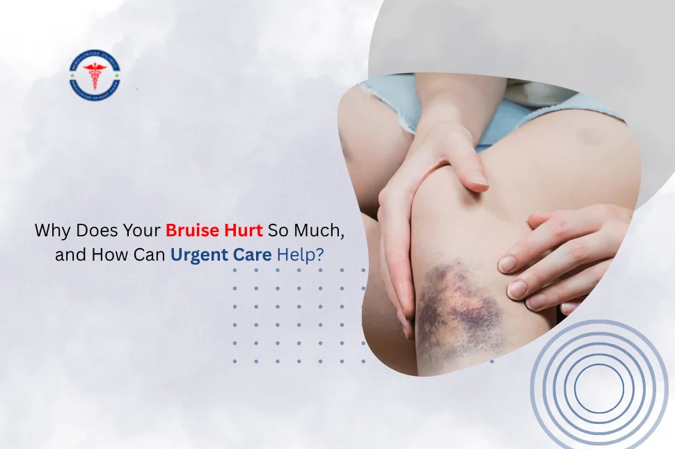 Bruise Hurt So Much and How Can Urgent Care Help